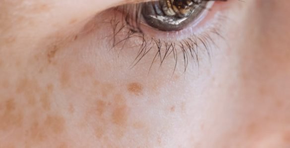 woman with freckles looking away